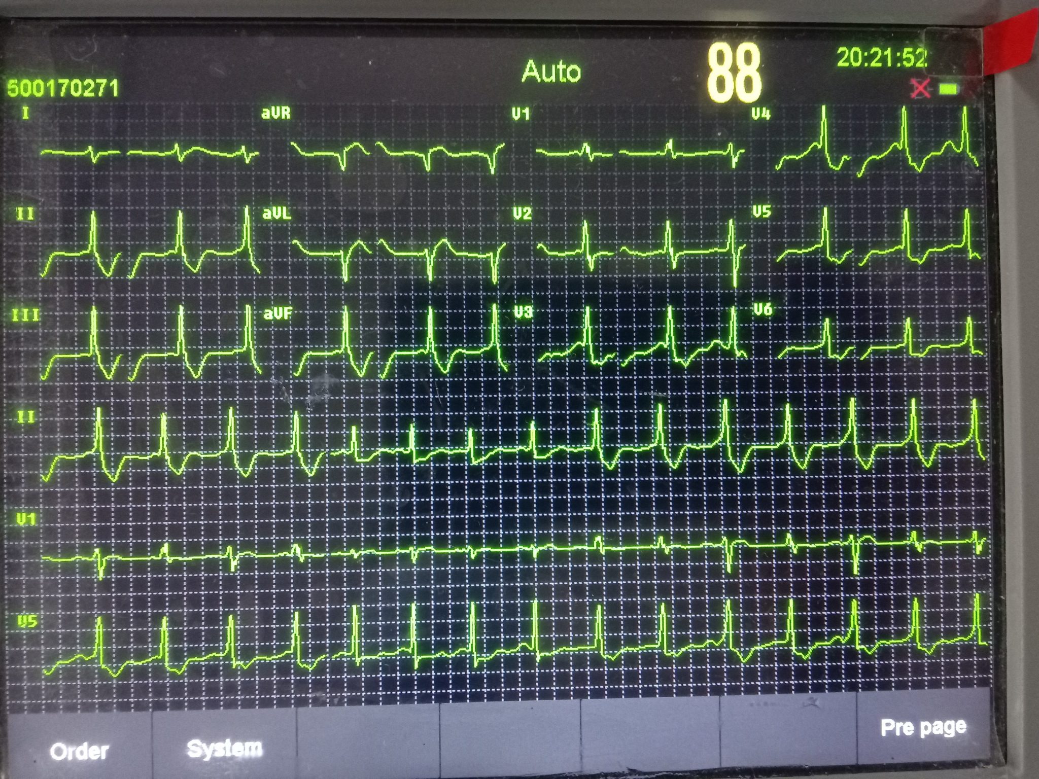 12 Lead ECG/EKG Machine w Interpretation Electrocardiograph Auto-analysed  Result