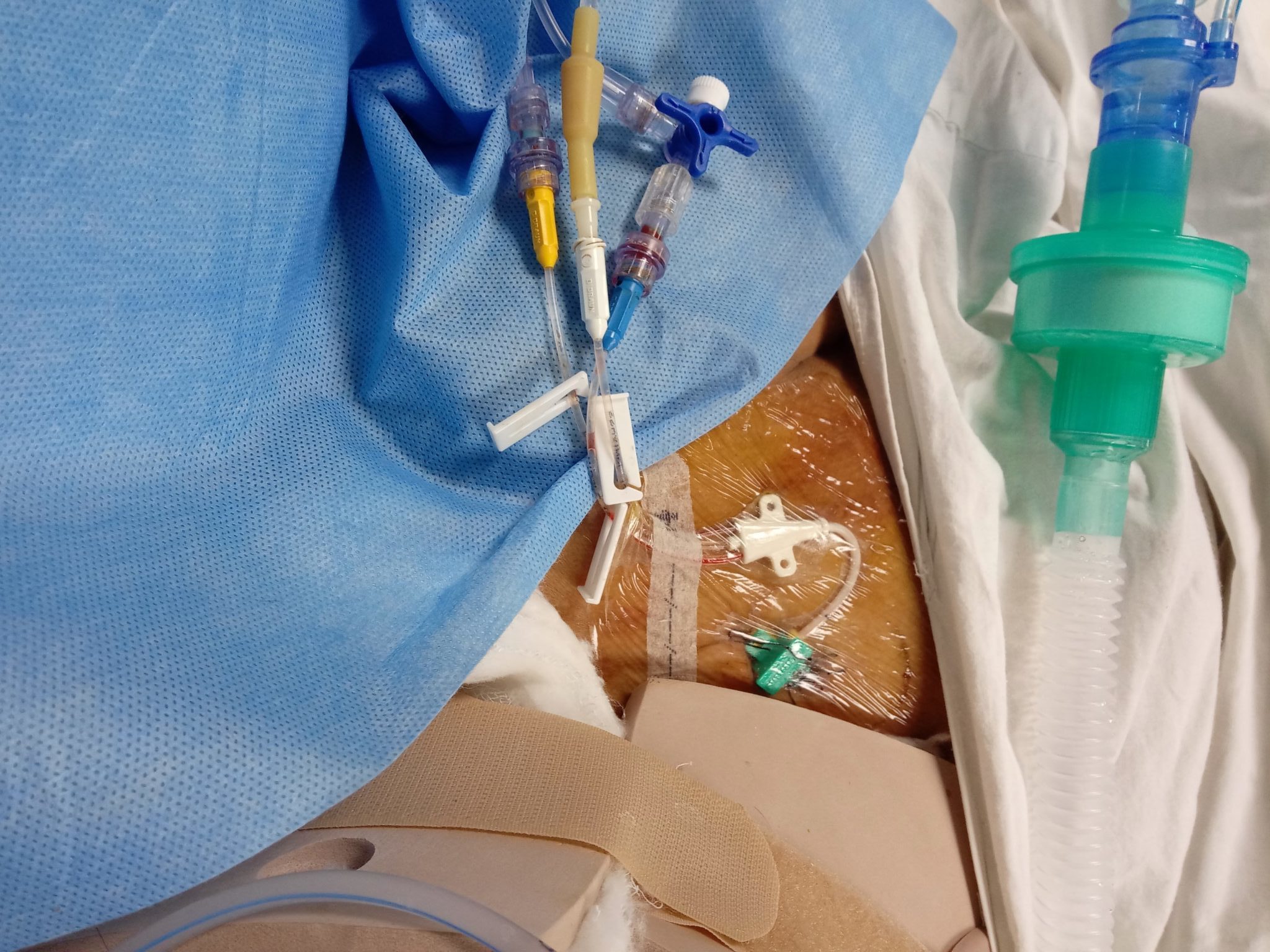 CVP Central Venous Catheter Placement Using Seldinger s Techniques