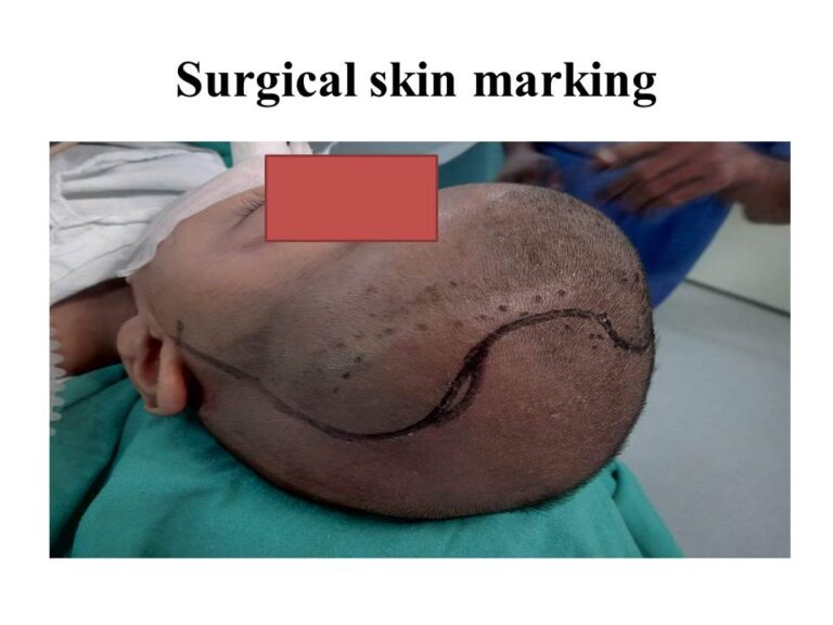 Surgical Skin Marker Used In Surgery