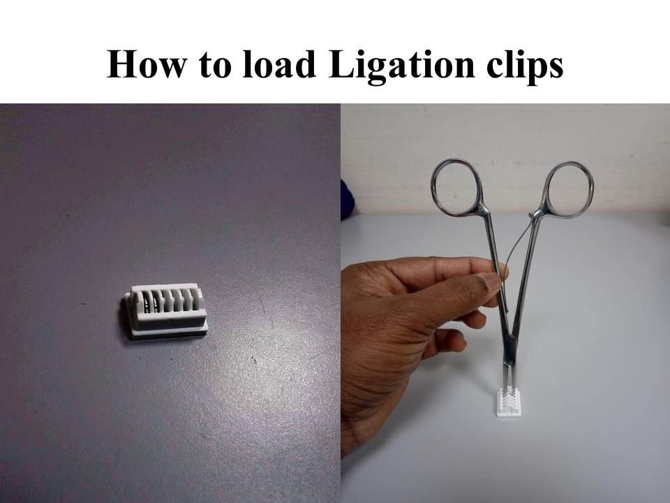 ligation clip application