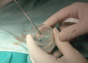 Biopsy sample Neurosurgery